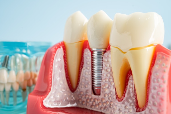 Teeth Replacement    : Dental Implants