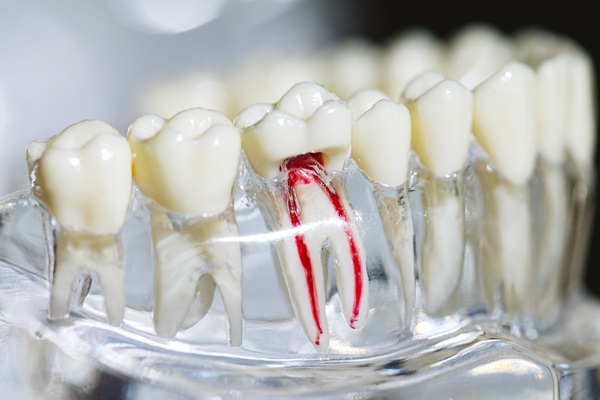 Indications For A Root Canal: What To Look Out For