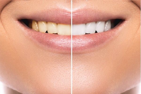 How Does In Office Teeth Bleaching Work?