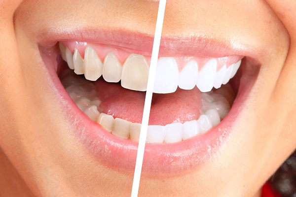 Are Dental Lasers Used In Cosmetic Dental Teeth Whitening?