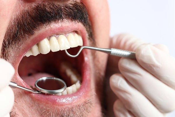 Does A Tooth Filling Last Forever?